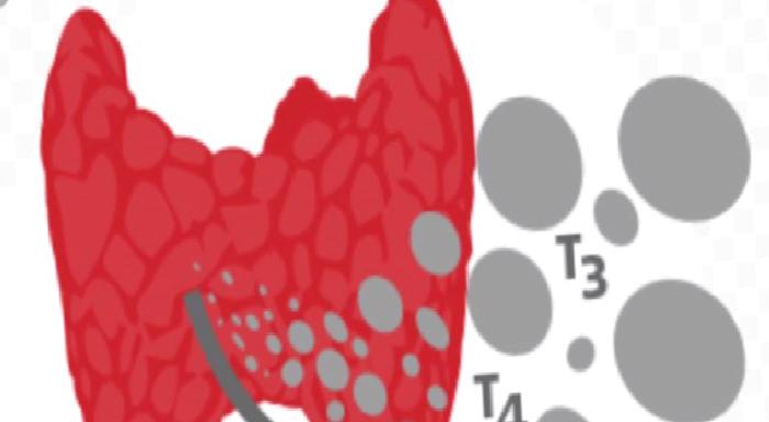 Hipertiroidi ve Cerrahi Tedavisi