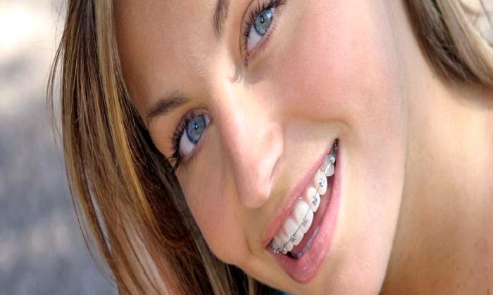 Hızlı Diş(Fastbraces) Teli Tedavisi