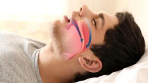 Horlama Hastalığı