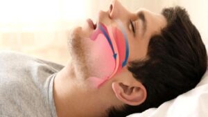 Horlama ve Tıkayıcı Uyku Apnesi