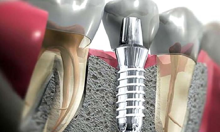 İmmediat (Anında) implant ; implantasyon yöntemi nedir?Kimlere uygulanabilir?