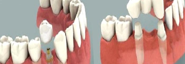 İMPLANT DİŞ HAKKINDA MERAK ETTİKLERİNİZ