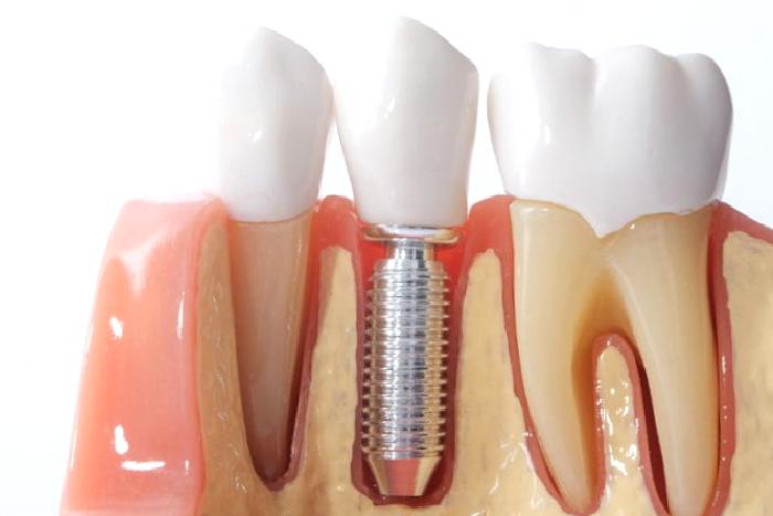 İmplant Mı, Gerçek Dişiniz Mi?