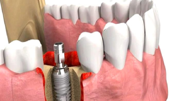 IMPLANT NEDİR KİMLER YAPTIRIR ?