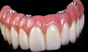 İmplant Tedavisi İle Bir Günde Sabit Dişler