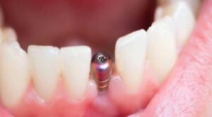 İmplantlarla İlgili Merak Ettikleriniz