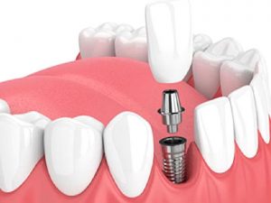 İmplantoloji Hakkında Bilinmesi Gerekenler?