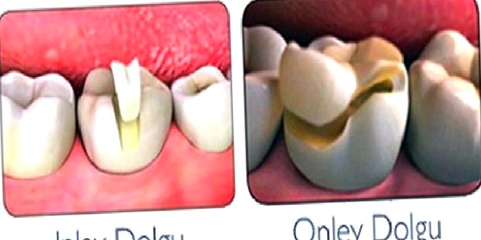 Inlay Onlay Estetik Dolgular