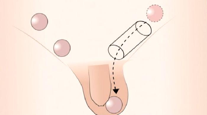 İnmemiş Testis Nedir?