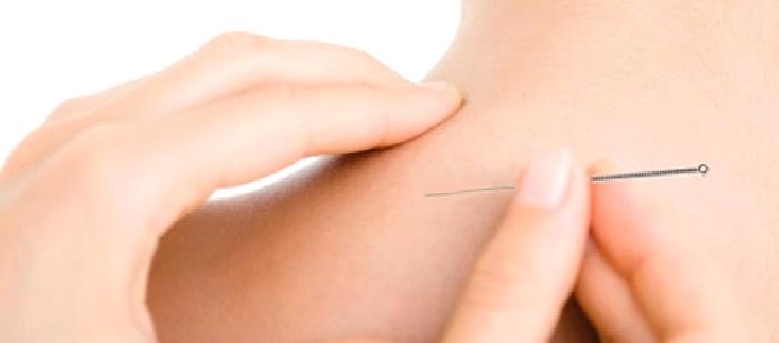 İntramüsküler Stimülasyon, Kuru İğne Tedavisi