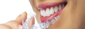 Invisalign