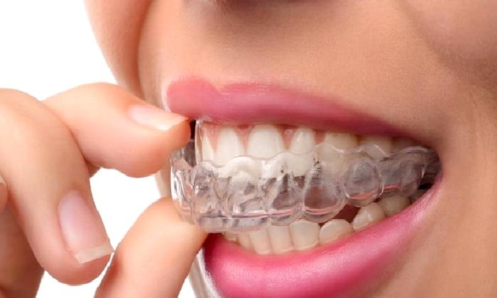 Invisalign Nedir?