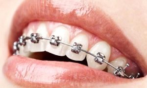 Invisalign Ortodonti Sistem