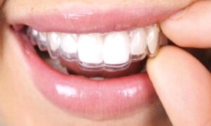 Invisalign Tedavisi