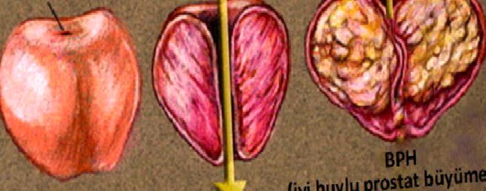 İyi Huylu Prostat Büyümesine Dikkat