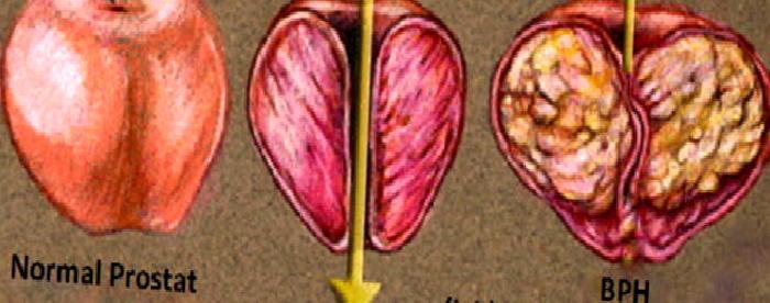 İyi Huylu Prostat Büyütme Ameliyatı