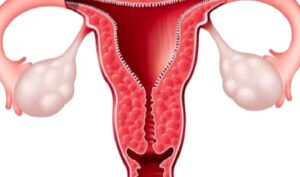 Jinekolojik Onkoloji Nedir ve Hangi Hastalıkları Kapsamaktadır?