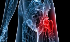 Kalça Kireçlenmelerinde PRP