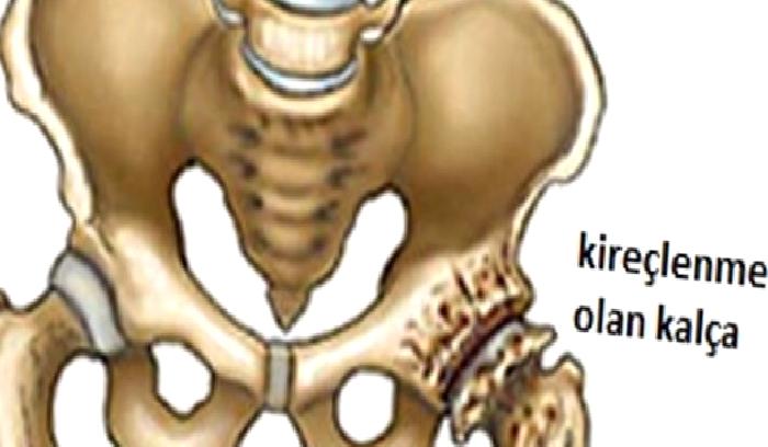 Kalça Kireçlenmesi Nedir?