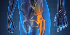 Kalça (Trokhanterik) Bursit