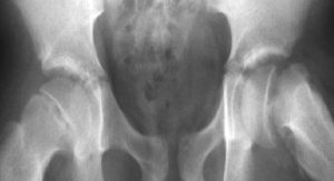 Kalçanın Geçici Osteoporozu
