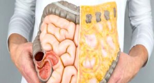 Kalın Bağırsak Kanseri Hakkında Merak Edilenler