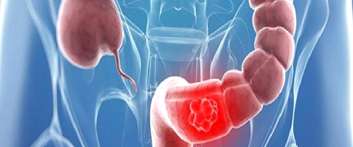 Kalın bağırsak kanserinde erken tanı ölüm oranını azaltıyor