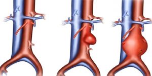 Kalp Hastalıkları Neden Arttı ve Tedavi Yöntemleri Neler?