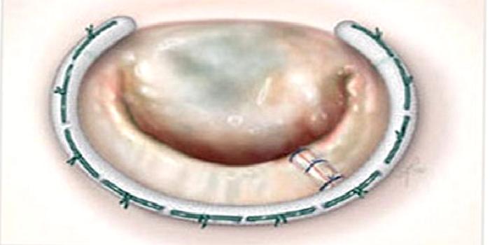 Kalp Kapağı Değiştirilen Hastalar Ve Yakınları için Açıklamalar