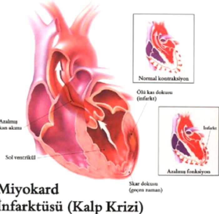 KALP KRİZİ NEDİR?