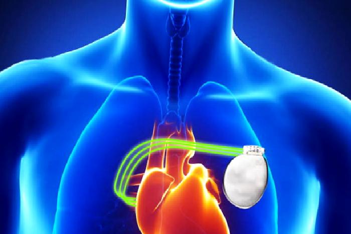 KALP PİLİ UYGULAMALARI KLASİK PACE MAKER (KALP PİLİ)