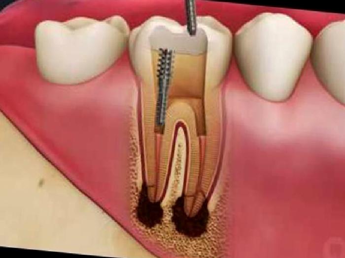 Kanal Tedavisi Süreci