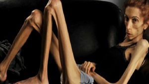 Kanserli Hastada Anoreksi-Kaşeksi Sendromu