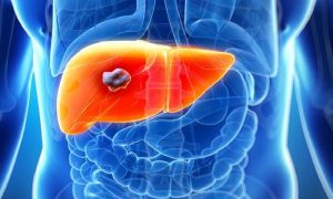 Karaciğer Kanseri: Sık Sorulan Sorulara Yanıtlar