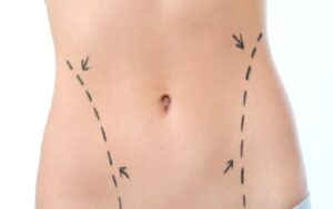 Karın Germe Ameliyatı