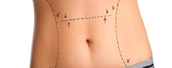 Karın Germe Ameliyatı (Abdominoplasti)