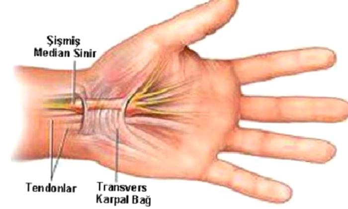 Karpal Tünel Sendromu
