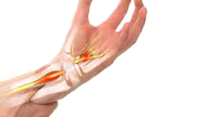 Karpal Tünel Sendromunu Hafife Almayın