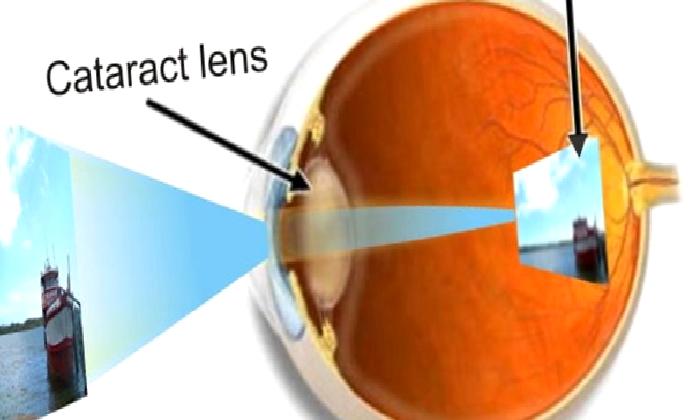 KATARAKT