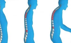 KEMİK KAYBINI ve OSTEOPOROZ’U ÖNLEMEKTE KURU ERİĞİN ÖNEMİ