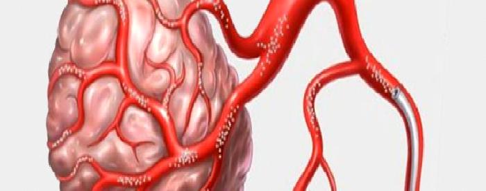 Kemoembolizasyon Nedir?