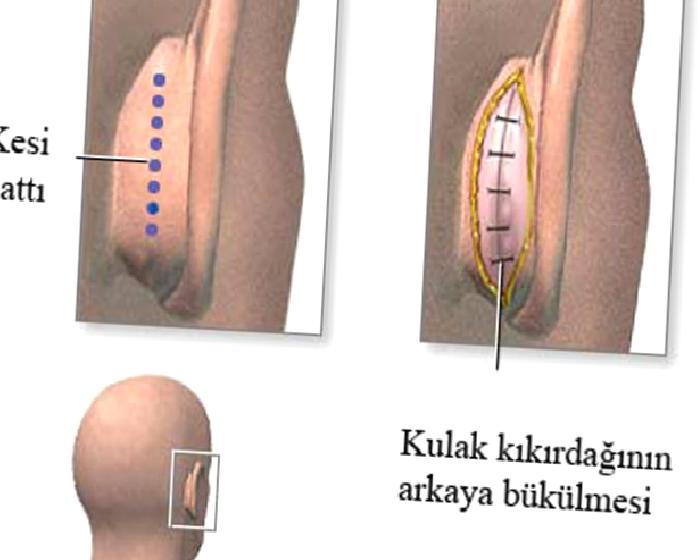 KEPÇE KULAK OPERASYONU