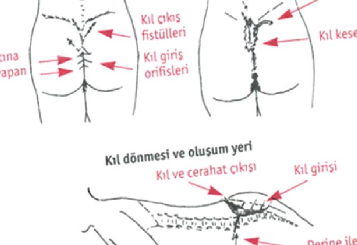 Kıl Dönmesi