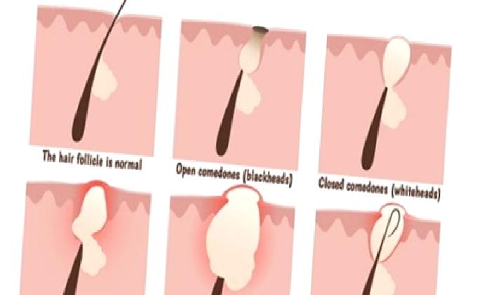 Kıl dönmesi nedir ? ( Pilonidal sinüs )