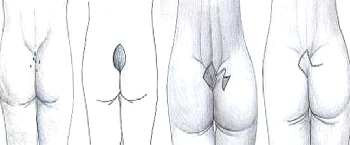 Kıl Dönmesi (Pilonidal Sinüs)