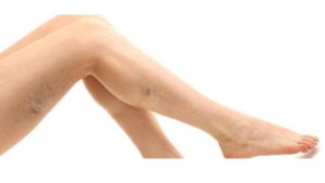 Kılcal Damar Çatlaması