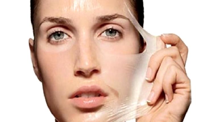 Kimyasal Peeling