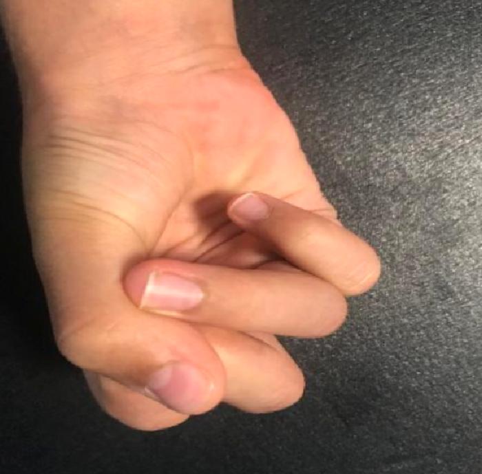 Kırık Komplikasyonları