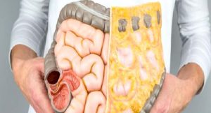 Kolon Kanseri (Kalın Bağırsak Kanseri)