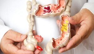 Kolon Kanserinin Belirtileri Neler? Kimler Risk Altında?